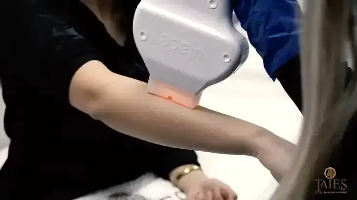 Lazer Epilasyonda Cihaz Seçimi